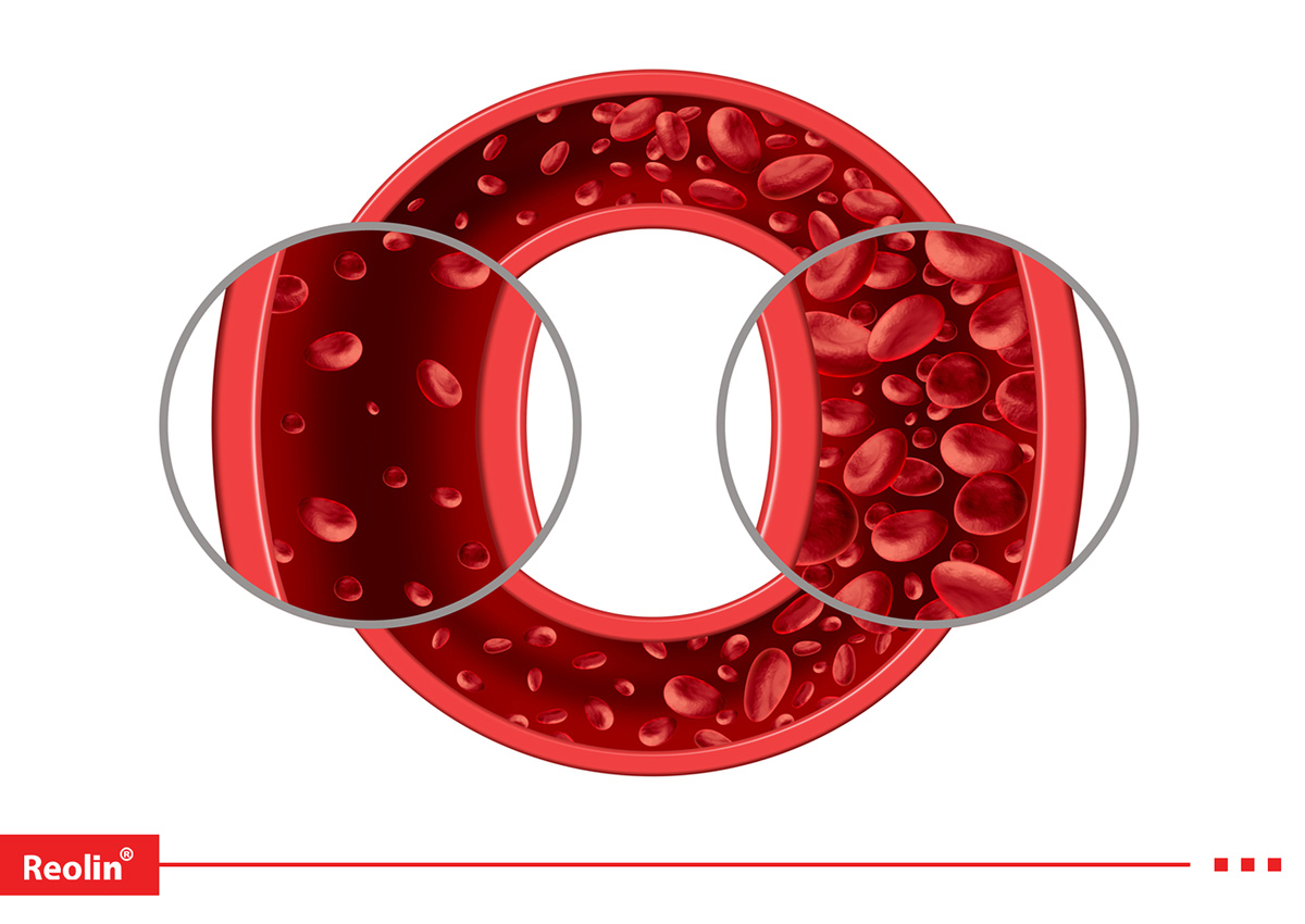 iron deficiency anemia