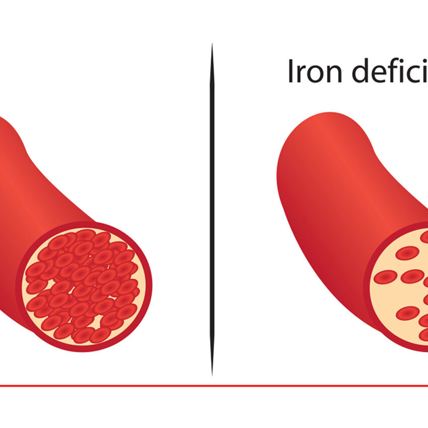10-approaches-to-treat-anemia treat anemia